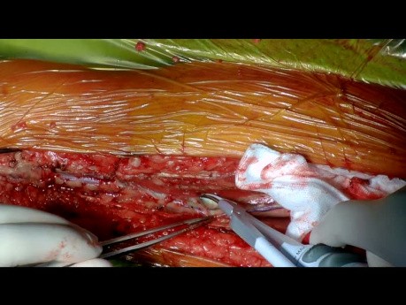 Entnahme der Radialarterie