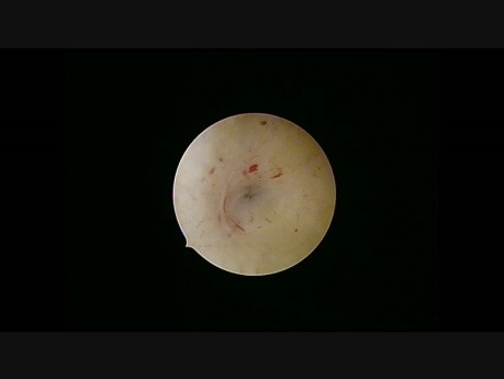 Essure-Sterilisation bei einer Patientin mit Hormonspirale Mirena