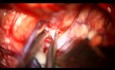 MCA Bifurkationsaneurysma Clipping
