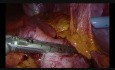 Die periphere laparoskopische Gastrektomie