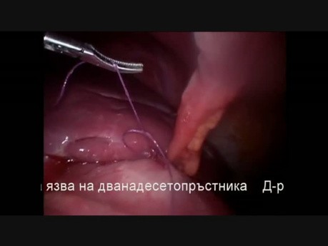 Laparoskopische Operation bei perforiertem Magengeschwür