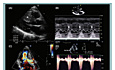 Echokardiographie bei hypertropher Kardiomyopathie
