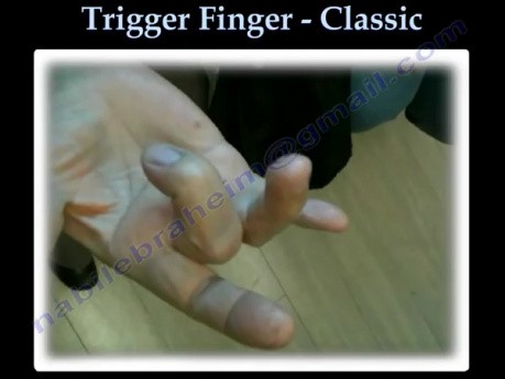 Der klassische Fall eines schnellenden Fingers