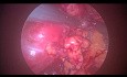Retroperitoneale laparoskopische Chirurgie zur Entfernung von zystischem Nierentumor