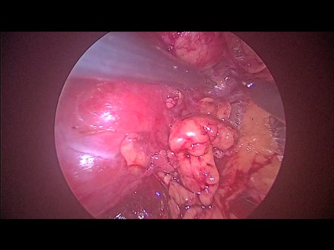 Urological surgical video clips