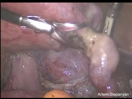 Breites Gebärmutterbandmyom an seltener Stelle. Laparoskopische Hysterektomie.