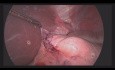 Organerhaltende Chirurgie für submukösen Tumor des abdominalen Teils der Speiseröhre