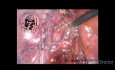 Laparoskopische Cholezystektomie und Erkundung des gemeinsamen Gallengangs