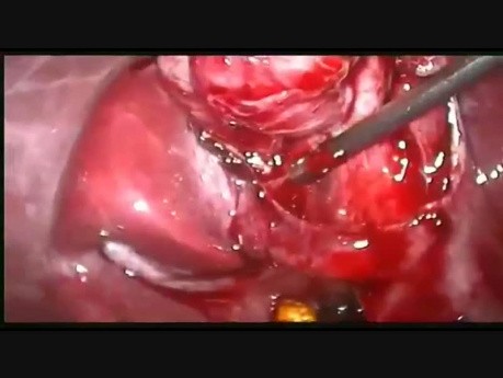 Nekrose des Ductus cysticus