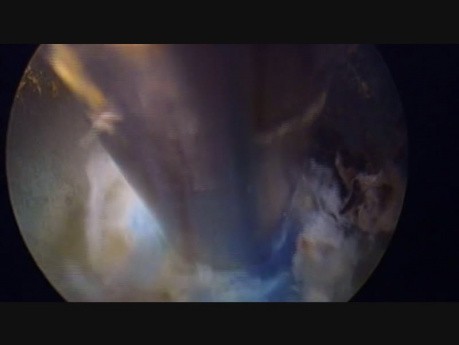 Endoskopische Chirurgie der Wirbelsäule