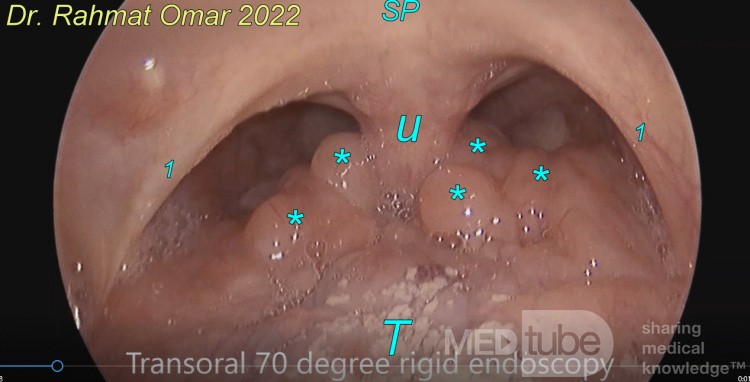 Zungenmandeln