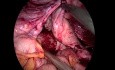 Resektion des Sigmadarmes - laparoskopisches Verfahren