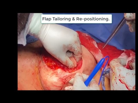Reverse-Mirrored Grissotti flap for central breast cancer: El-Erian's Modification 
