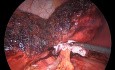 Laparoskopische Radiofrequenz-Leberresektion bei Adenomen