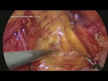 Minimalinvasive Mesh-Fixierung bei einer laparoskopischen Leistenhernienreparatur - ein didaktisches Video