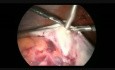 Laparoskopische Behandlung von großer Ovarialmasse