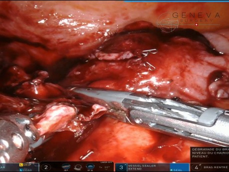 Robotische Appendektomie bei retrozökaler Appendizitis mit Abszess