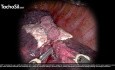 Einsatz von TachoSil® in der robotischen Thoraxchirurgie bei verschiedenen Fällen und Indikationen, einschließlich Hämostase, Aerostase und Lymphostase, präsentiert von Prof. Baste