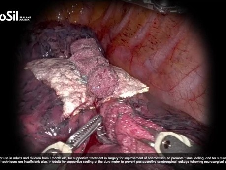 Einsatz von TachoSil® in der robotischen Thoraxchirurgie bei verschiedenen Fällen und Indikationen, einschließlich Hämostase, Aerostase und Lymphostase, präsentiert von Prof. Baste