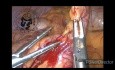 Laparoskopische Appendektomie bei akuter Appendizitis