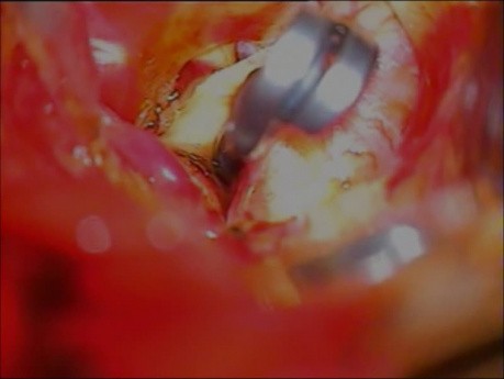 Gehirnaneurysma – hinteres kommunizierendes Aretrie-Aneurysma – Mikrochirurgie