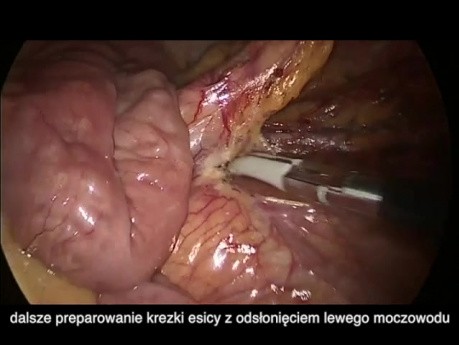 Subtotale laparoskopische Kolektomie