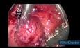 Transanale endoskopische Mikrochirurgie