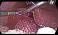 Effekt der Anwendung von Nähten auf Blutungen aus dem Leberbett während der laparoskopischen Cholezystektomie.