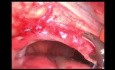 Laparoskopische Netzreparatur einer linken Zwerchfellhernie bei einem Patienten mit Magenvolvulus