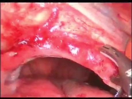 Laparoskopische Netzreparatur einer linken Zwerchfellhernie bei einem Patienten mit Magenvolvulus