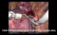 Komplexe pulmonale Segmentektomie – S9+10 links 