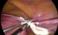 Totale laparoskopische Hysterektomie 