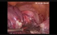 Totale laparoskopische Hysterektomie und bilaterale Salpingo-Oophorektomie (Dr.Avijit Basak)