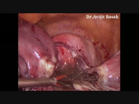 Totale laparoskopische Hysterektomie und bilaterale Salpingo-Oophorektomie (Dr.Avijit Basak)