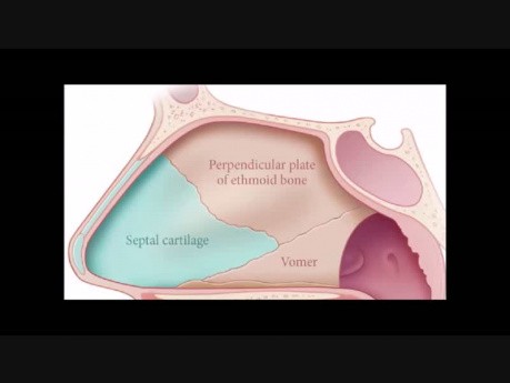 Septumplastik