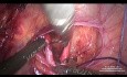 Präparation und Ligation der Uterusarterie