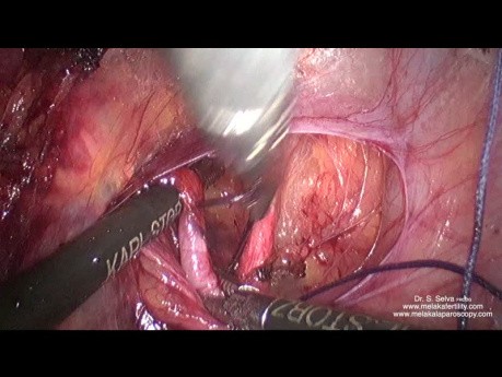Präparation und Ligation der Uterusarterie