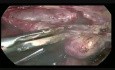 Totale Laparoskopische Hysterektomie (TLH) und Bilaterale Salpingo-Oophorektomie (BSO)