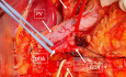 Leberarterie hinter der Pfortader