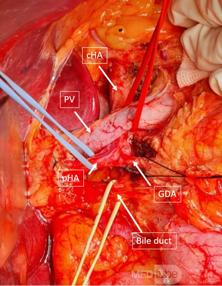Leberarterie hinter der Pfortader