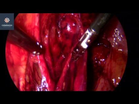 Endometriose-Operation bei Unfruchtbarkeit