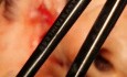 Osteom im nasoethmoidalen Bereich