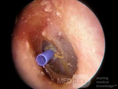 Mittelohrdrainage - T-Tube