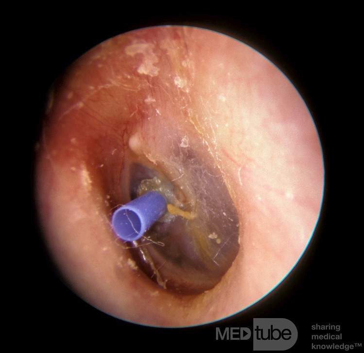 Mittelohrdrainage - T-Tube