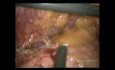 Laparoskopische totale Gastrektomie mit D2-Lymphadenektomie bei einem übergewichtigen Patienten (vollständiges Video)