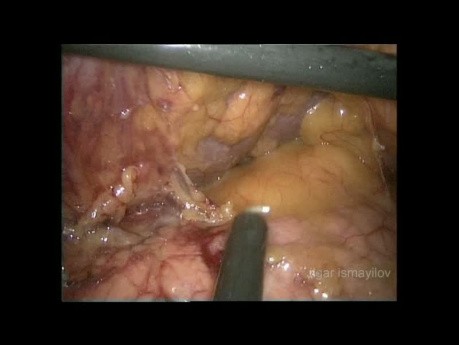 Laparoskopische totale Gastrektomie mit D2-Lymphadenektomie bei einem übergewichtigen Patienten (vollständiges Video)