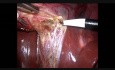 Laparoskopische Cholezystektomie + Reparatur von Umbilikalhernien + Tubenligatur