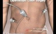 Darmkrebs Chirurgie - 3D medizinische Animation