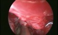 Endoskopische Entfernung der Pyozele der Kieferhöhle
