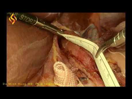 Laparoskopische Myotomie nach Heller mit Fundoplikatio nach Dor